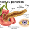 Une combinaison de trois médicaments pour traiter le cancer du pancréas