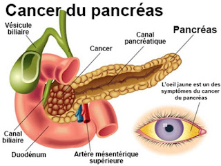 Une combinaison de trois médicaments pour traiter le cancer du pancréas