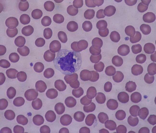 La monocytose 